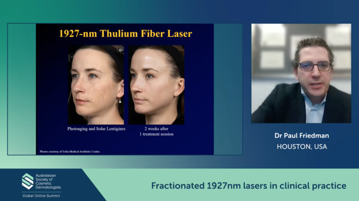Fractionated 1927nm lasers in clinical practice – Paul Friedman