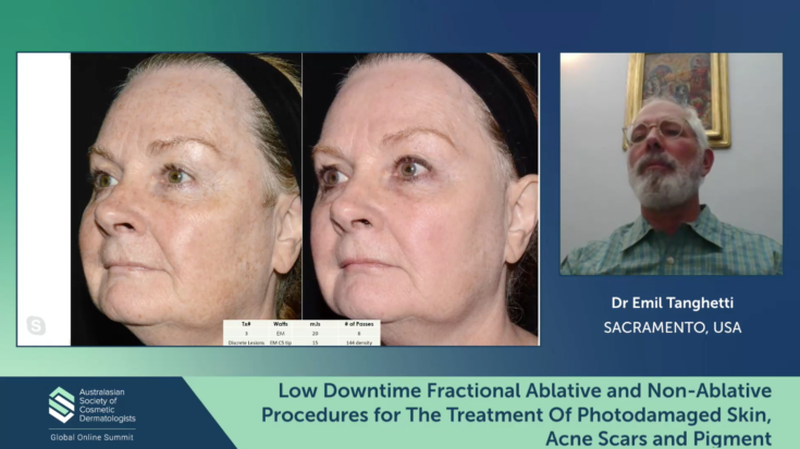 Low Downtime Fractional Ablative and Non-Ablative Procedures for The Treatment Of Photodamaged Skin, Acne Scars and Pigment – Emil Tanghetti
